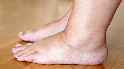 Fluid Retention (In Later Stages)